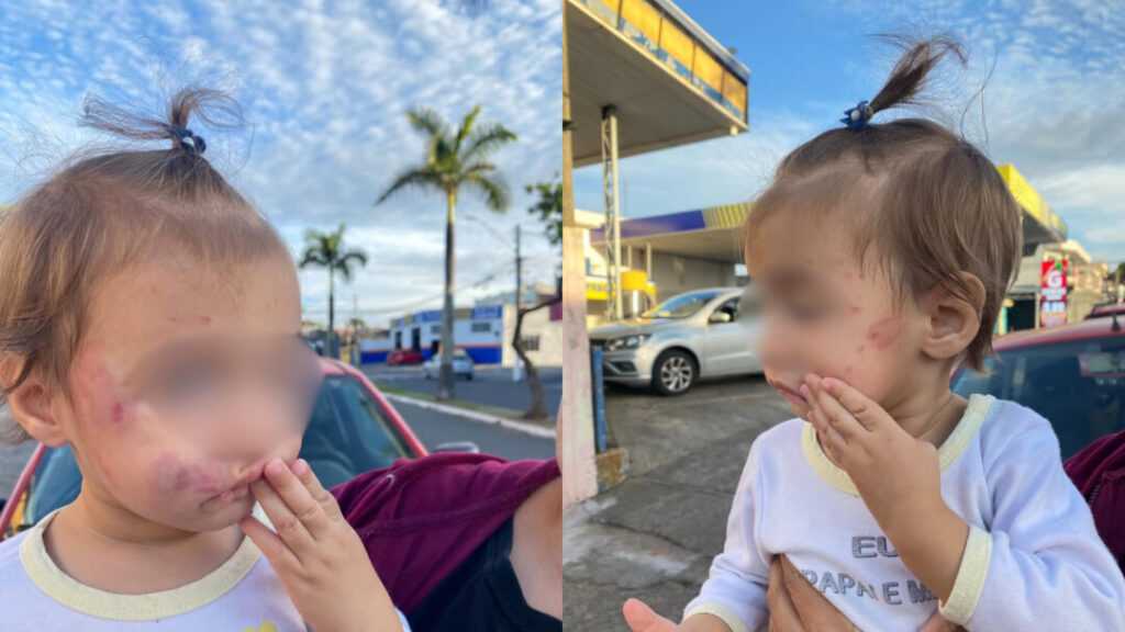 sumare-rompe-contrato-com-creche-em-que-bebe-levou-mordidas-no-rosto